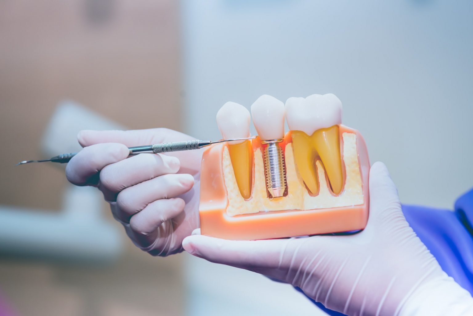 Dental Implants Are a Great Way To Replace Missing Teeth