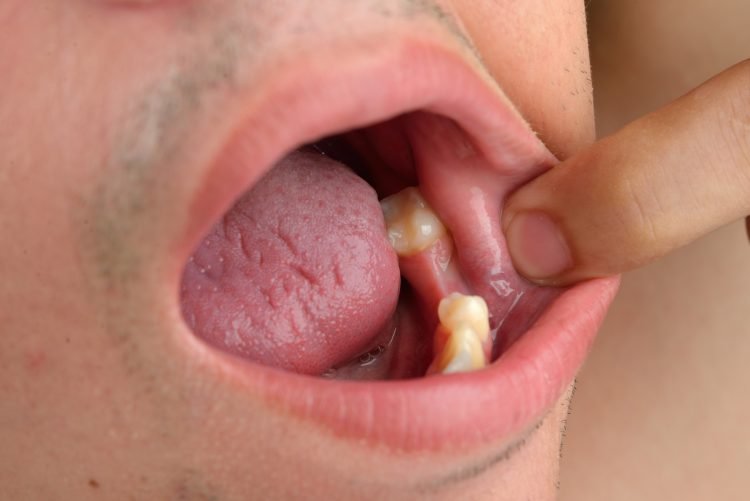 An Alveoloplasty Is An Oral Surgery Treatment Empire Ortho An alveoloplasty is an oral surgery treatment empire ortho