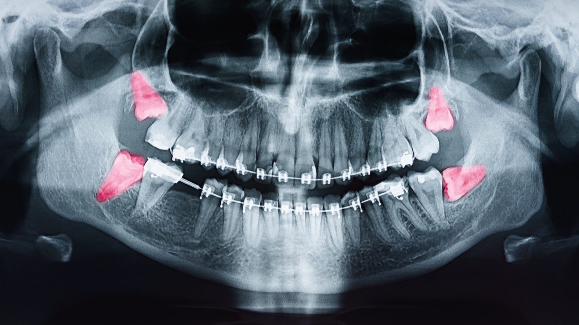 Wisdom Teeth Extraction: What to Expect Before, During, and After Recovery